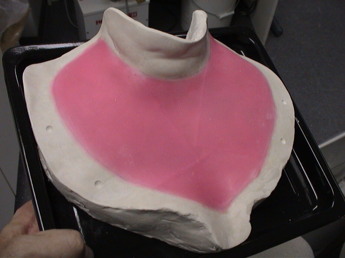 wax pattern for scar cover prosthesis