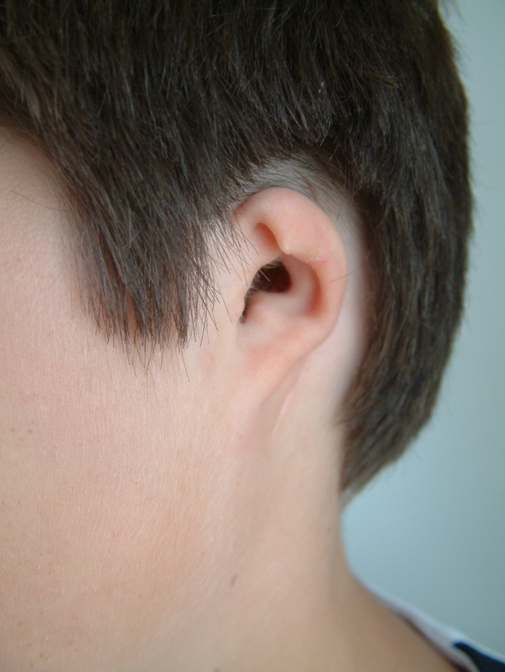Grade 2 Microtia