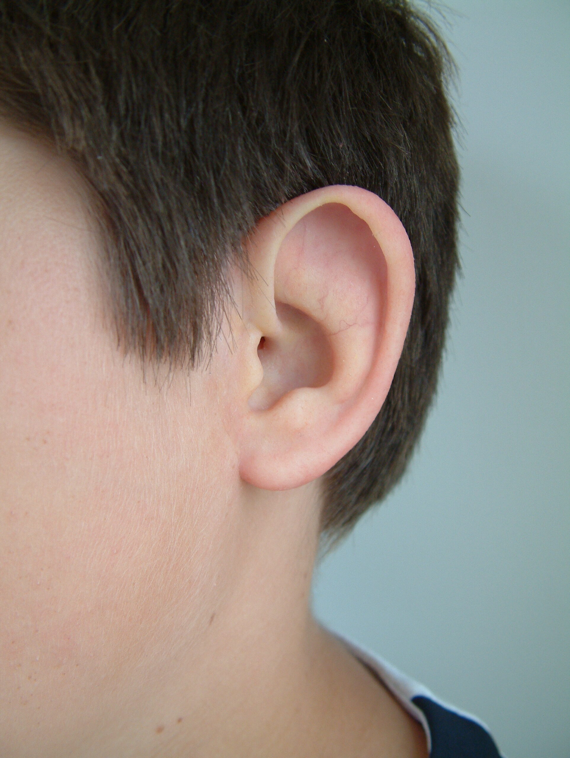 Ear prosthesis for treating grade 2 microtia