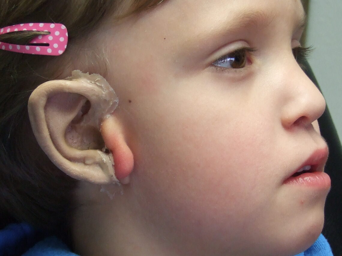 Fitting a boy with wax ear prototype