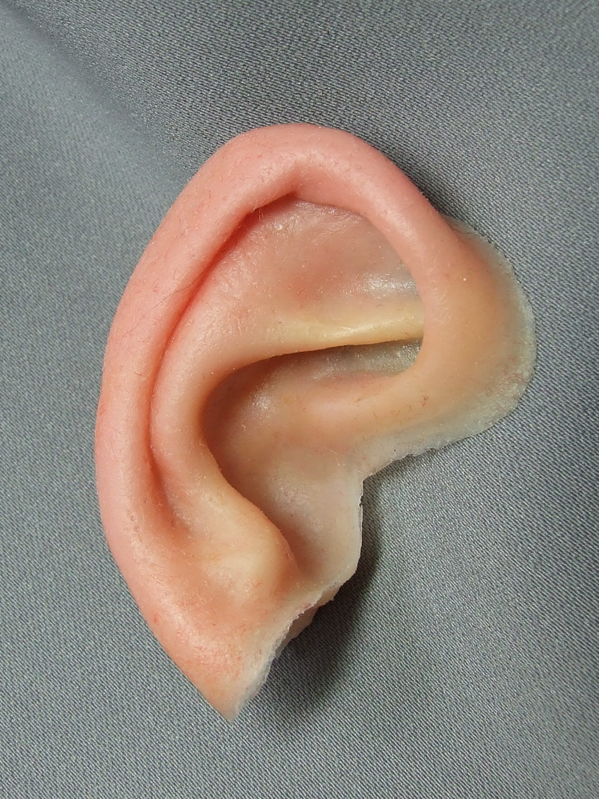 ear prosthesis to improve grade 3 microtia