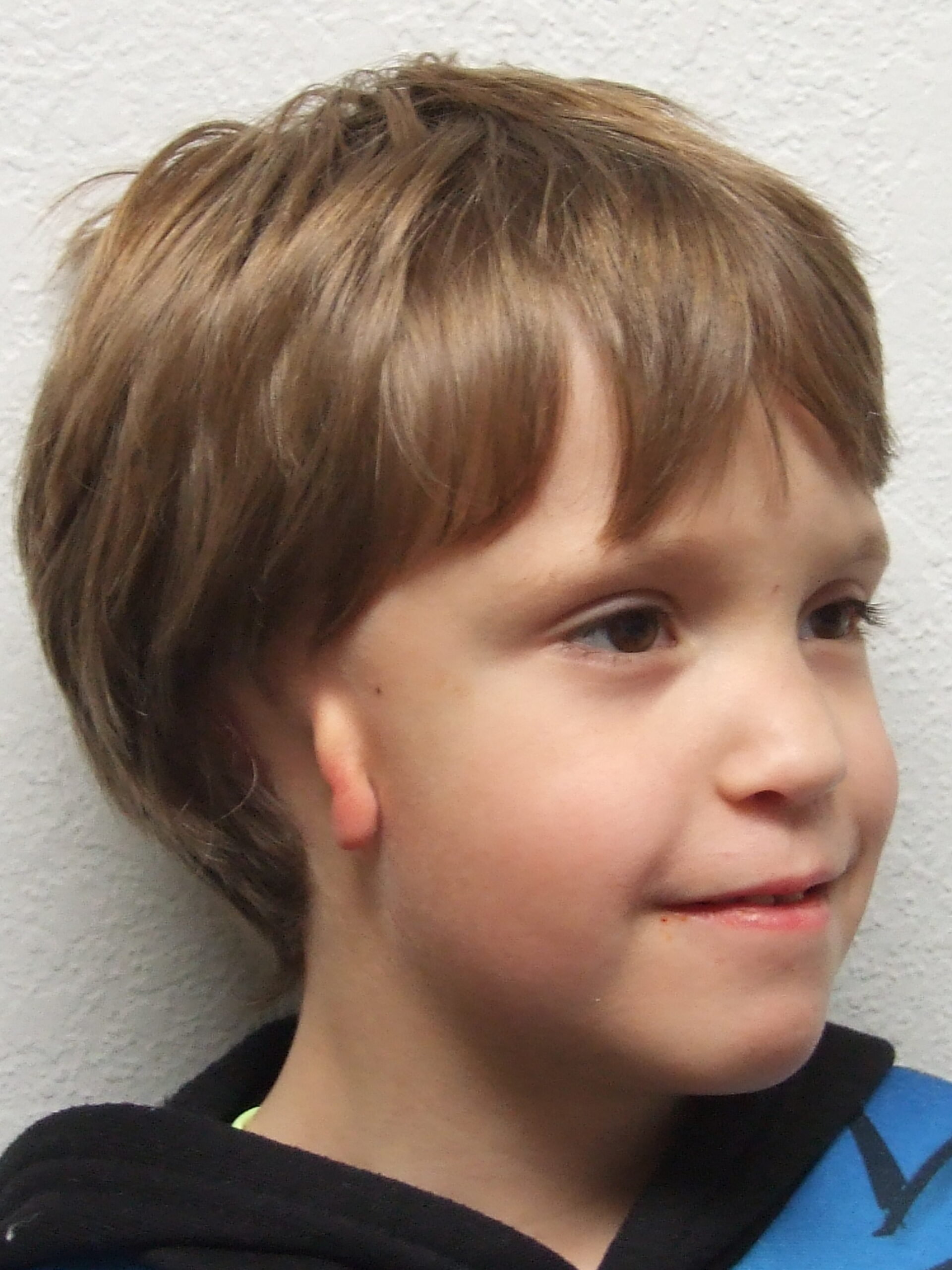 pictuer of boy with grade 3 microtia