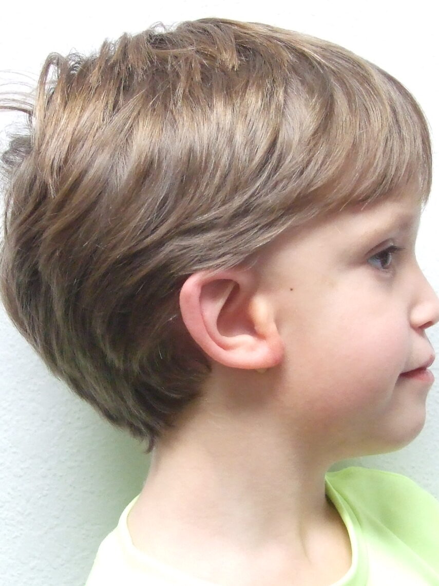 boy wearing ear prosthesis to fix grade 3 microtia