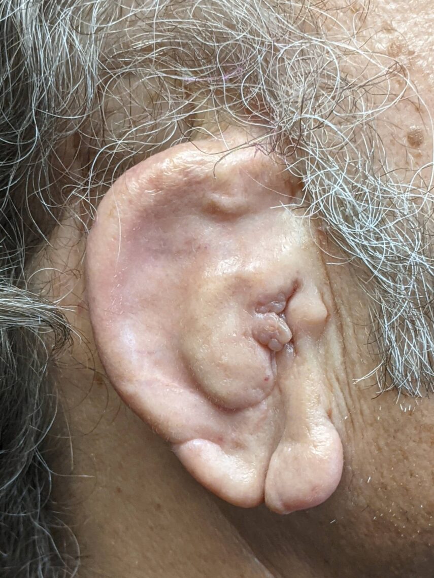 photo of Bulky unsatisfactory autologous ear reconstruction