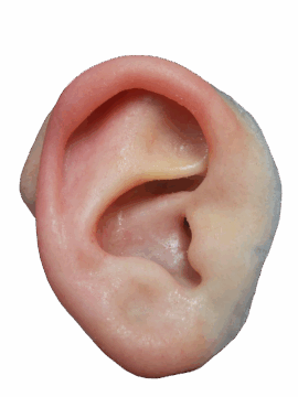 photo of child's ear prosthesis for microtia