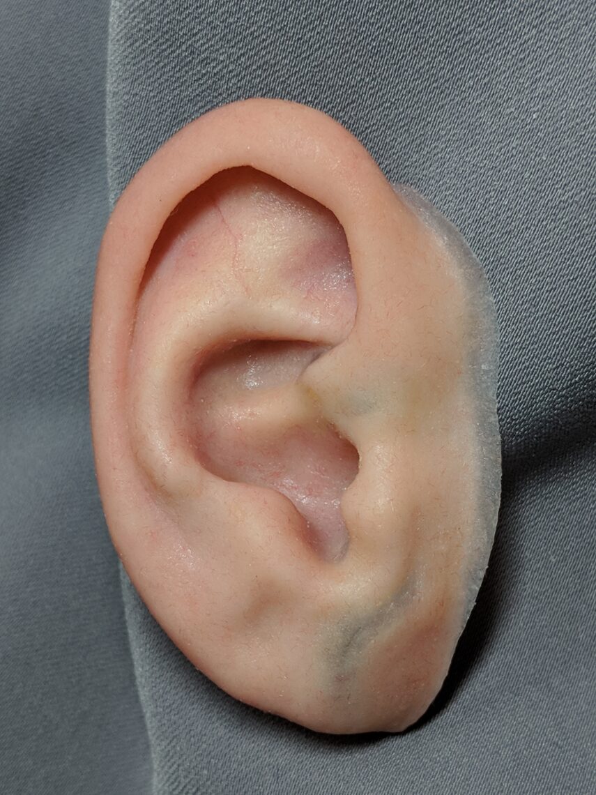 Prosthetic ear for microtia