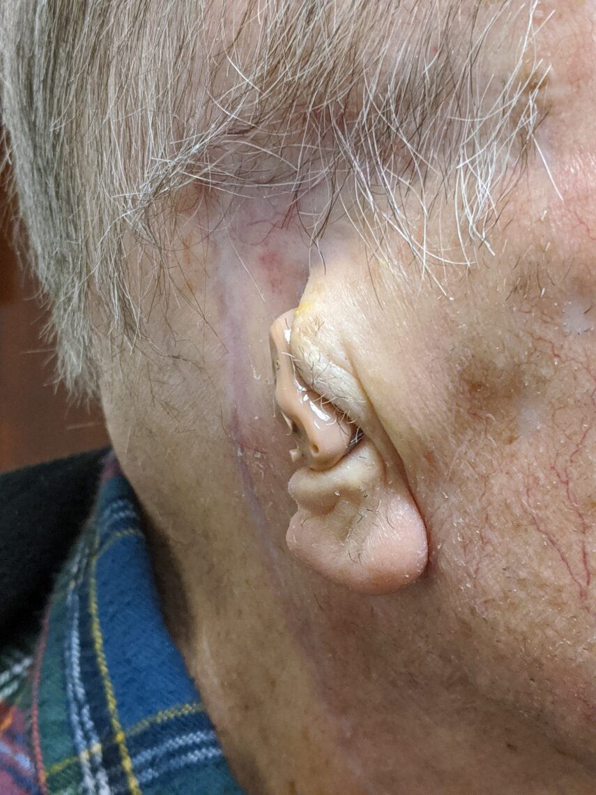 subtotal auriculectomy with remnant lobule