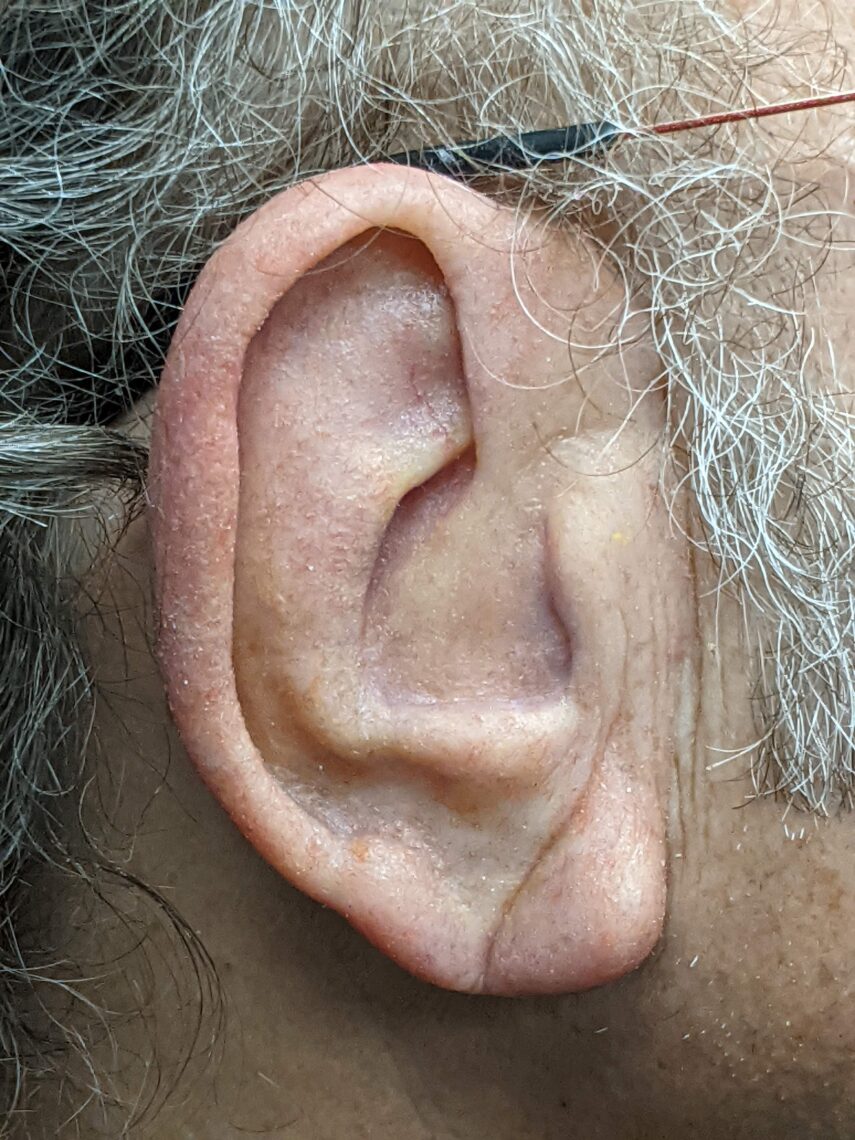 very accurate coloration in a prosthetic ear that improves the rib cartilage ear reconstruction