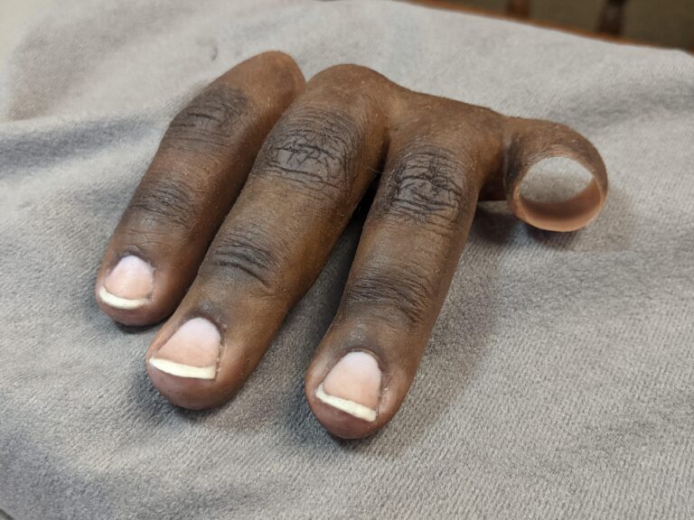 dark skinned prosthesis with 3 lifelike fingers
