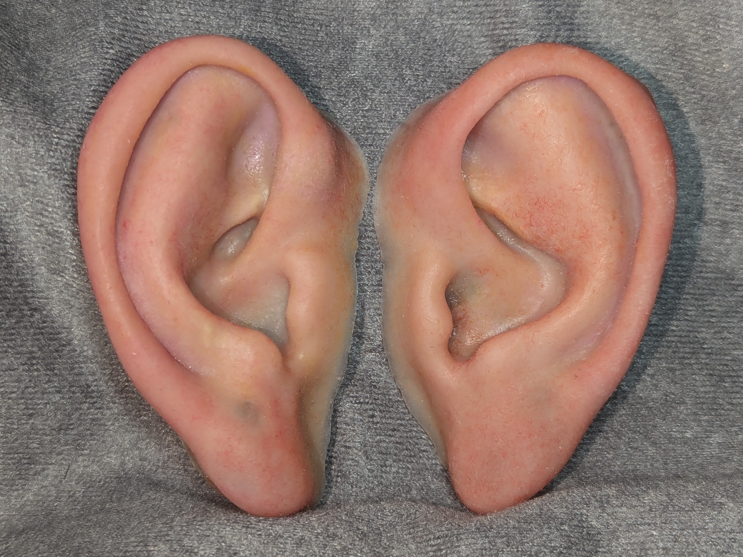 bilateral implant retained prosthetic ears
