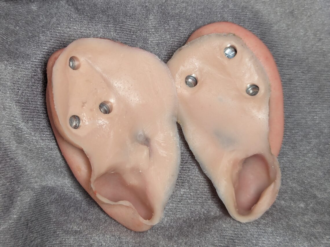 bilateral magnetic ear prosthetics