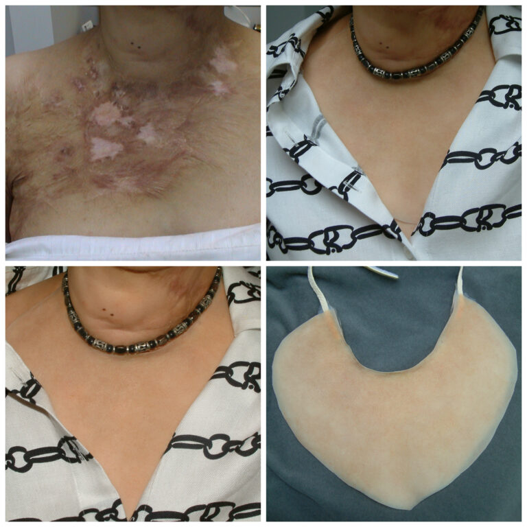 collage of a woman wearing a scar cover over her chest burns
