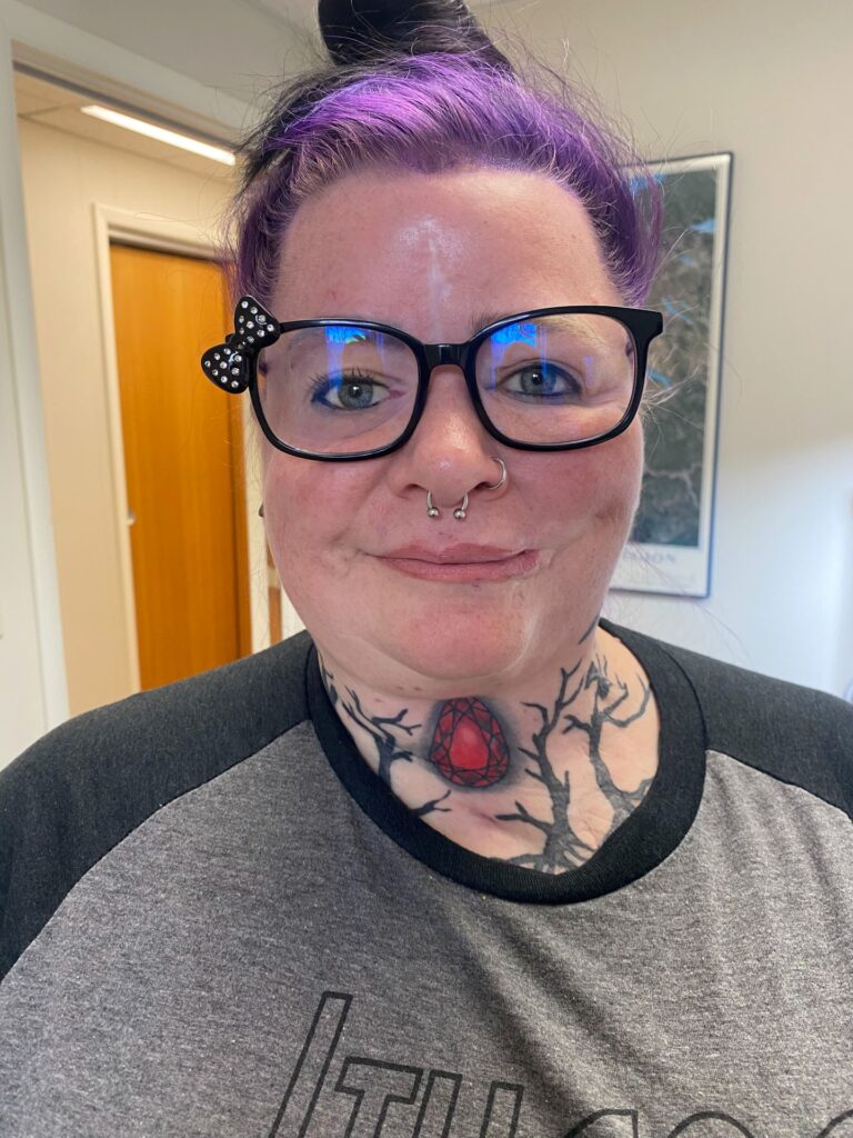 picture of young woman wearing orbital prosthesis with large glasses and smiling