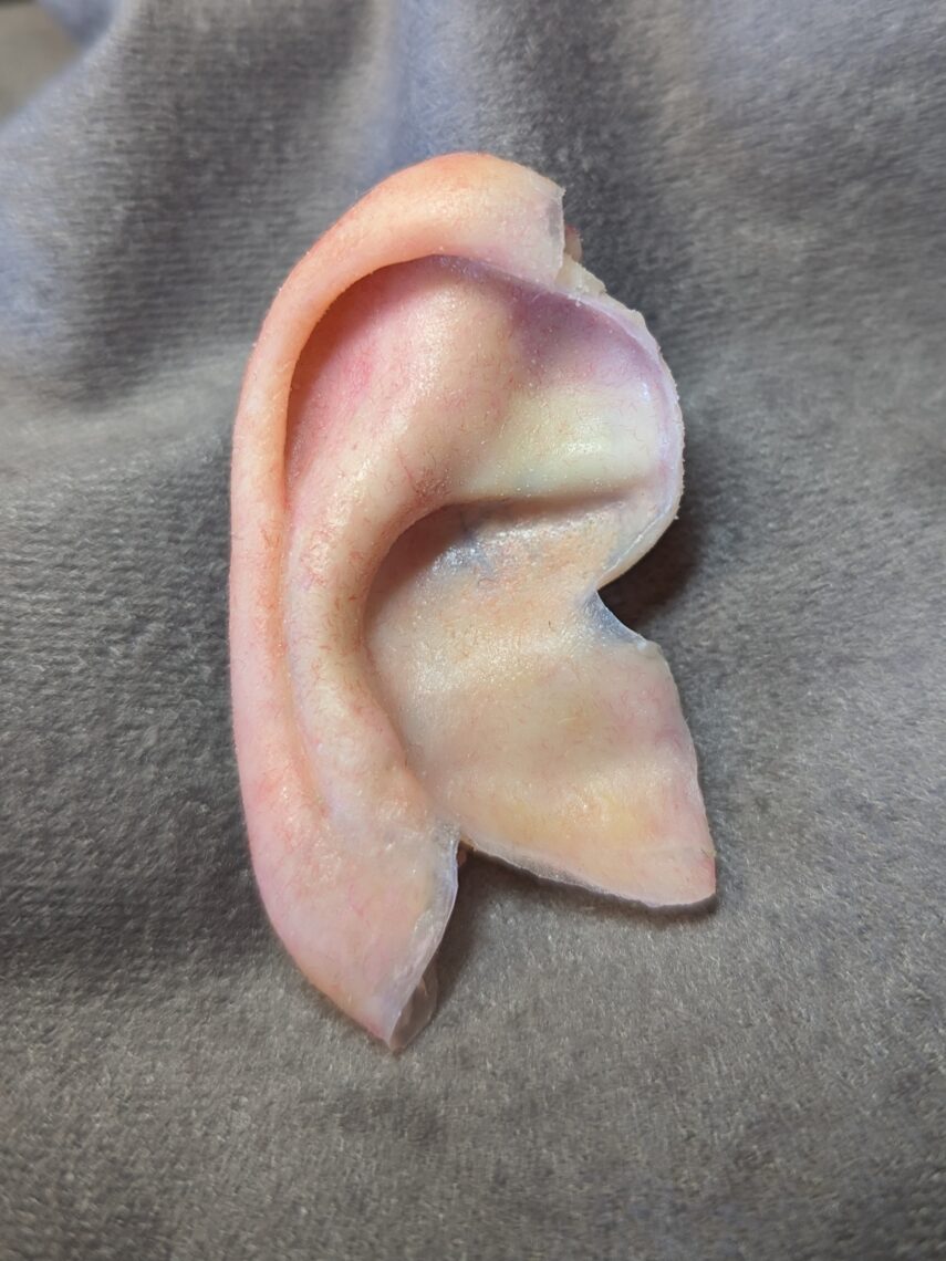 partial ear prosthesis
