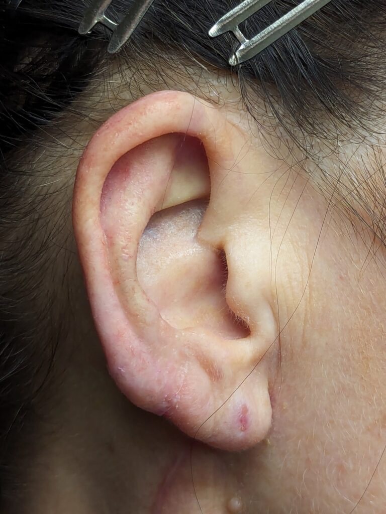 prosthetic ear in place like puzzle piece fit