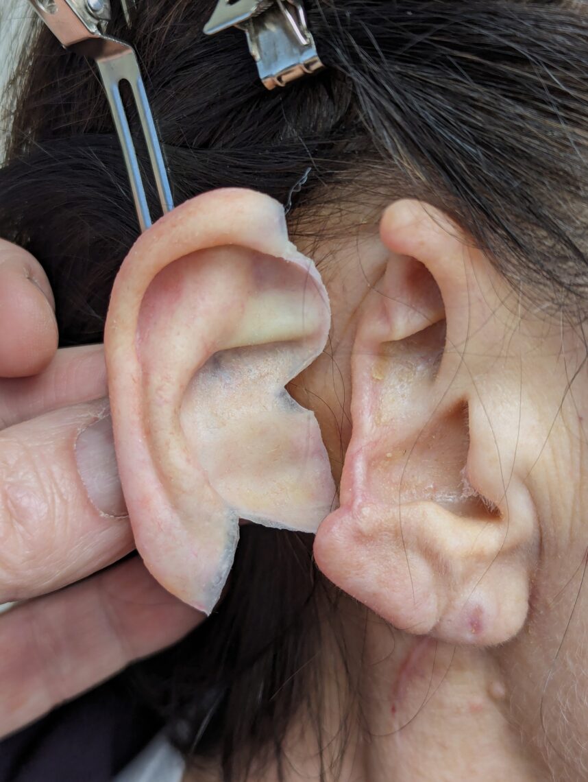 subtotal auriculectomy and ear prosthesis