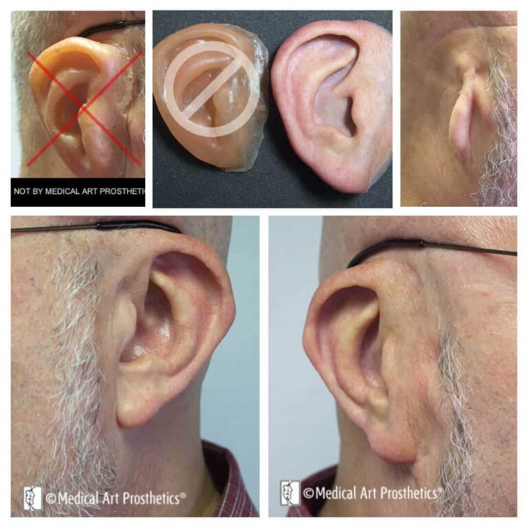 collage of obsolete and improved ear prosthetics