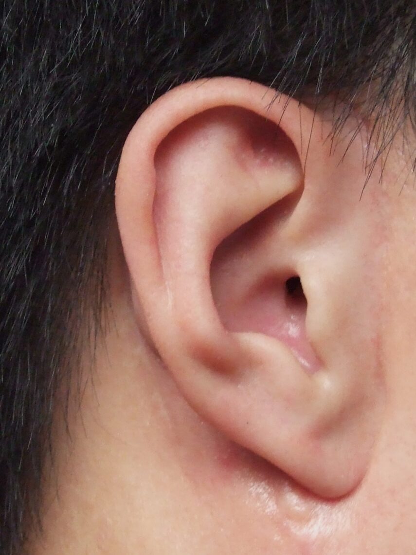 prosthetic ear attached by clips on bar
