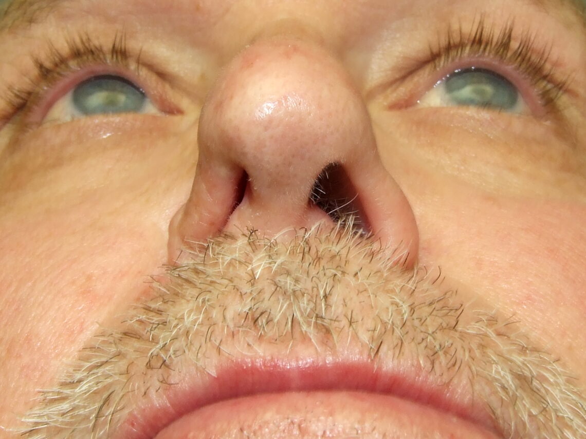 collapsed ala and airway