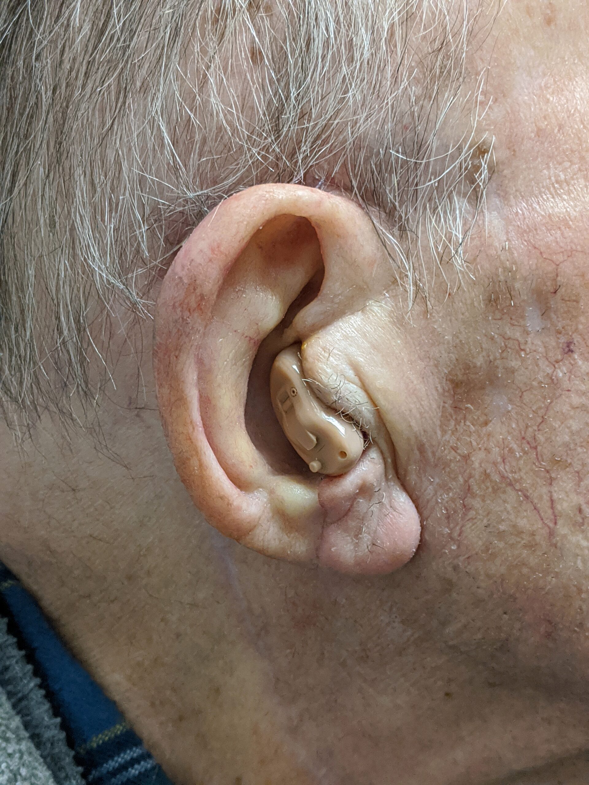 prosthesis restoration of upper ear