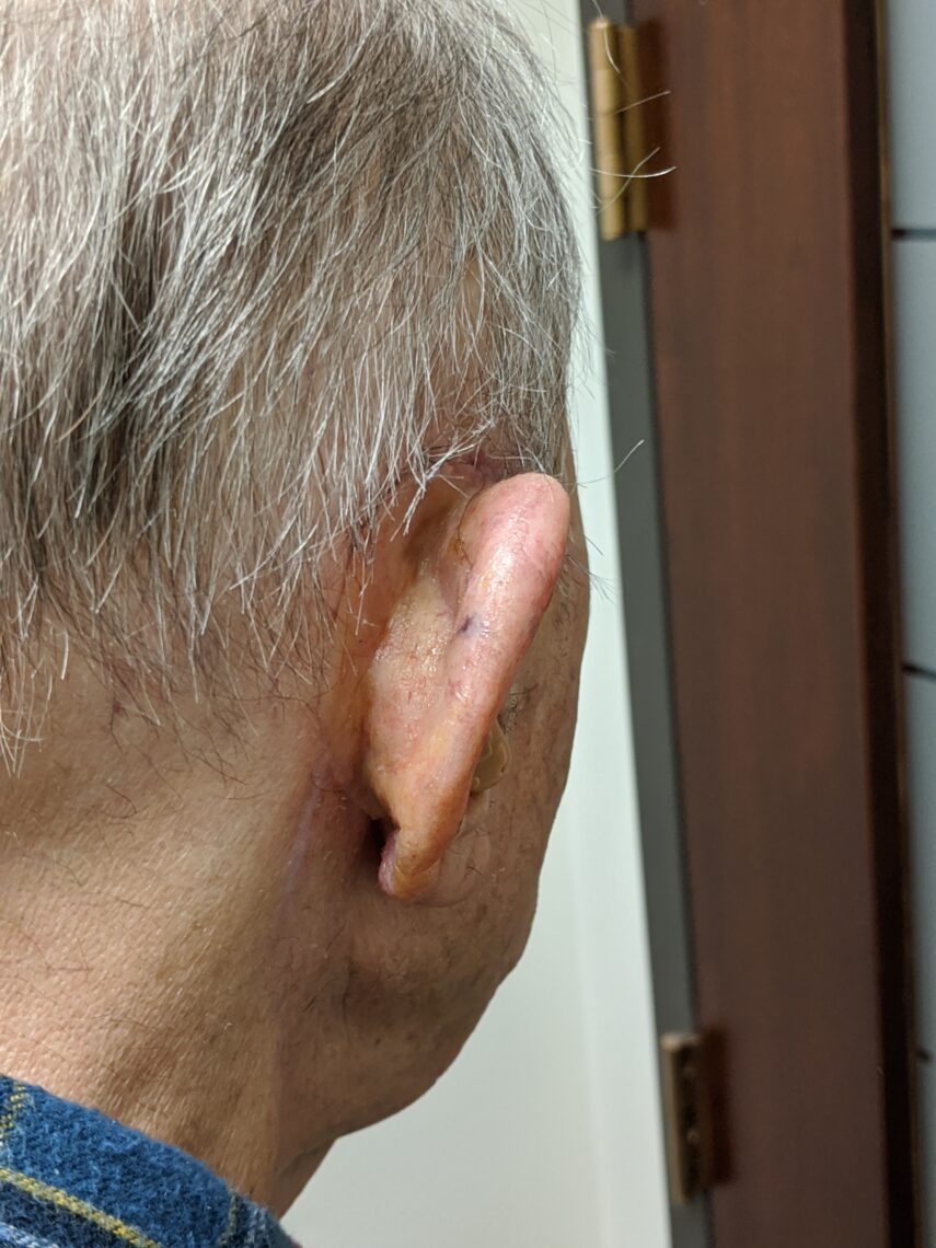 back of prosthetic ear where glasses will hold it in place