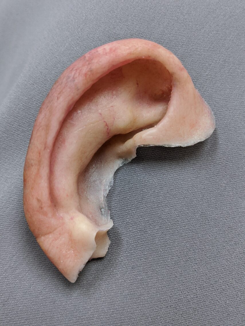 upper half ear prosthesis
