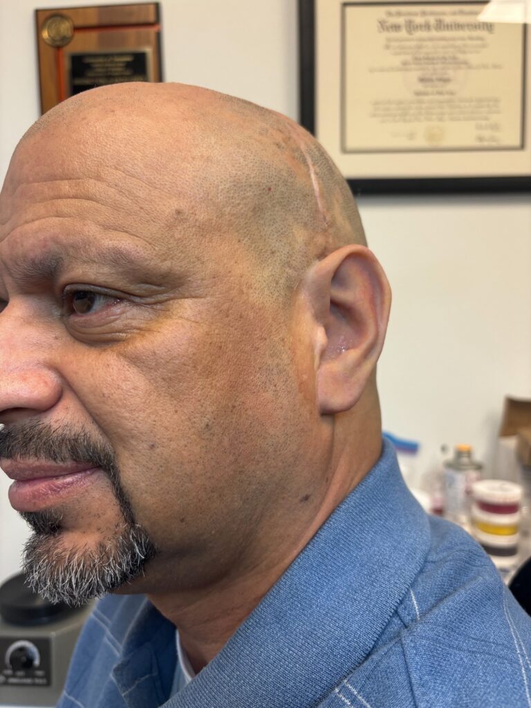 Man wearing artistic ear prosthesis