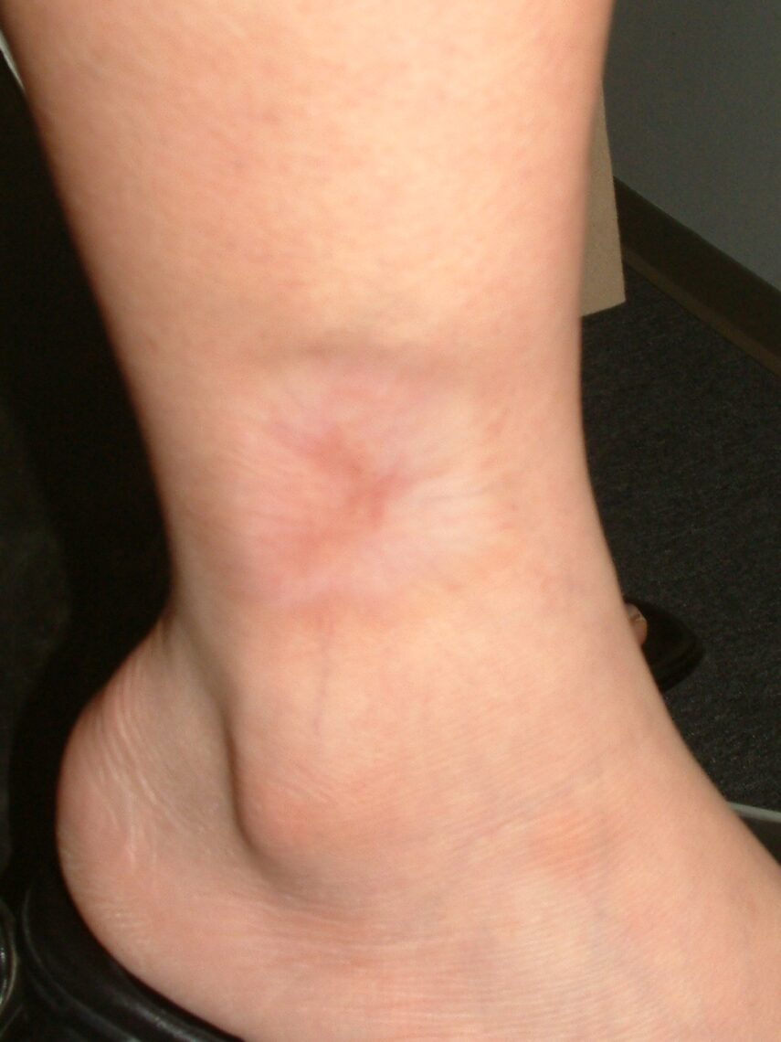 photo of scar on lower leg before correction