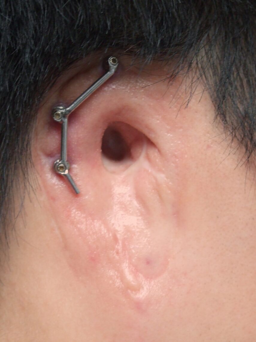 osseointegration bar for ear prosthetics