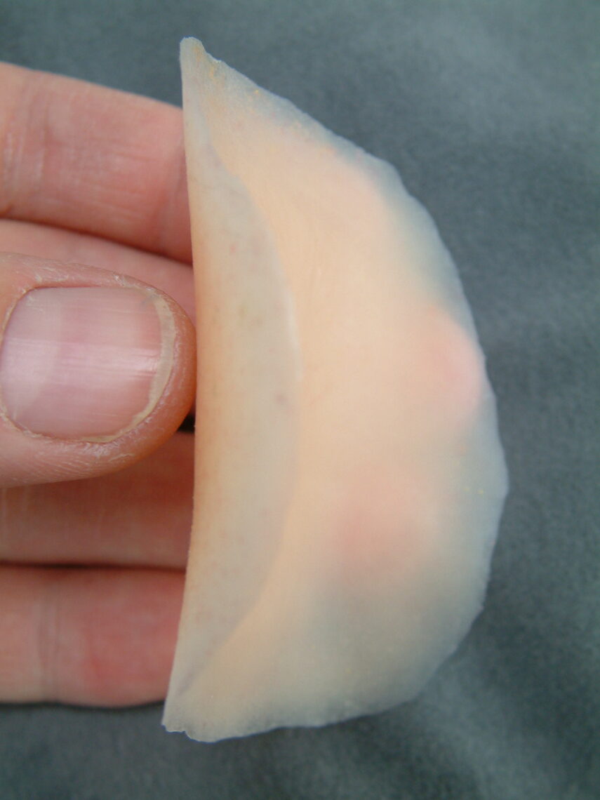 photo of the backside of a custom silicone scar cover for lower leg defect