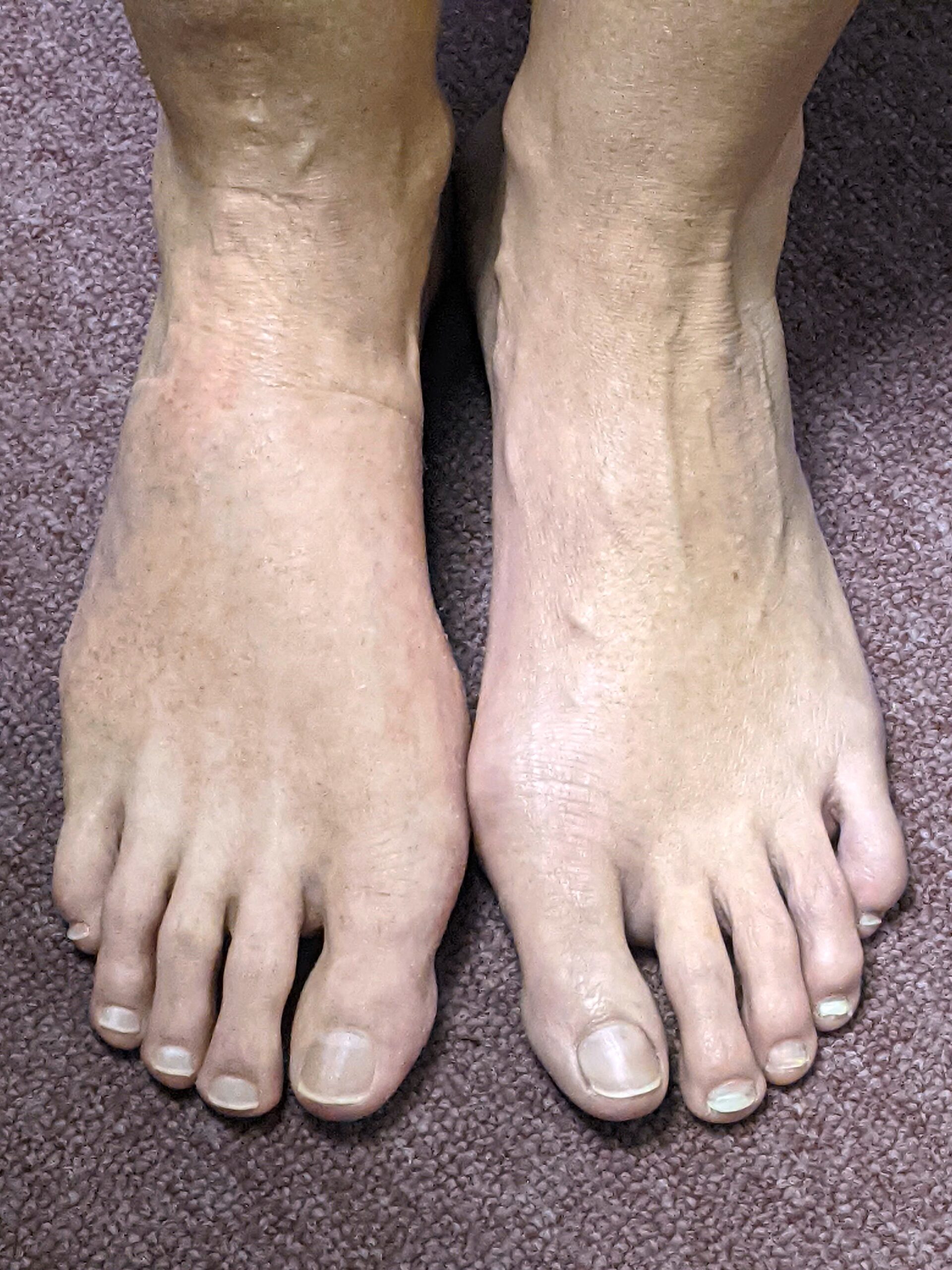 picture of prosthetic foot repair of deformed foot