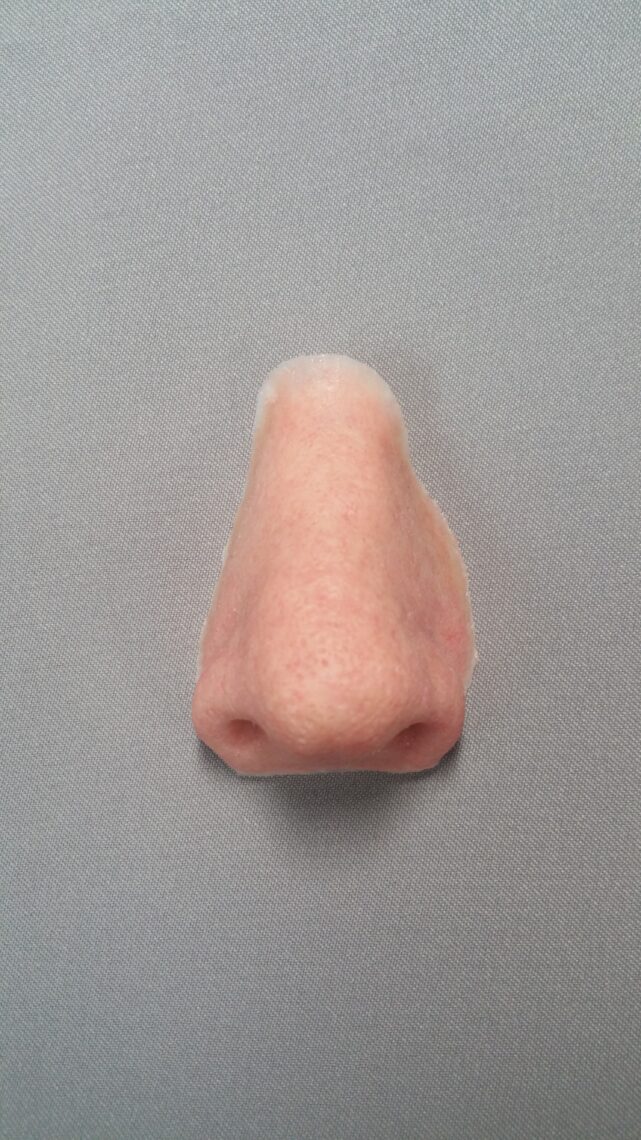 a bar-clip nose prosthesis