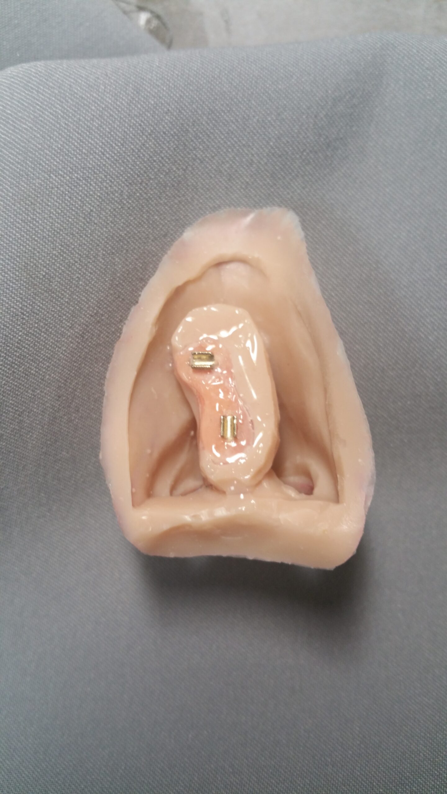 picture showing inside of a nasal prosthesis with gold clips