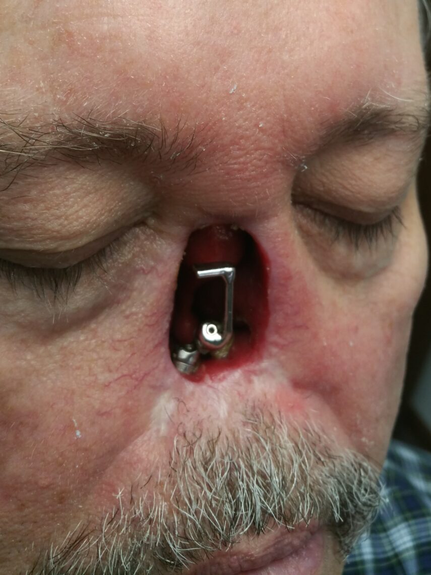 picture of a rhinectomy patient with a bar-clip osseointegration attachment
