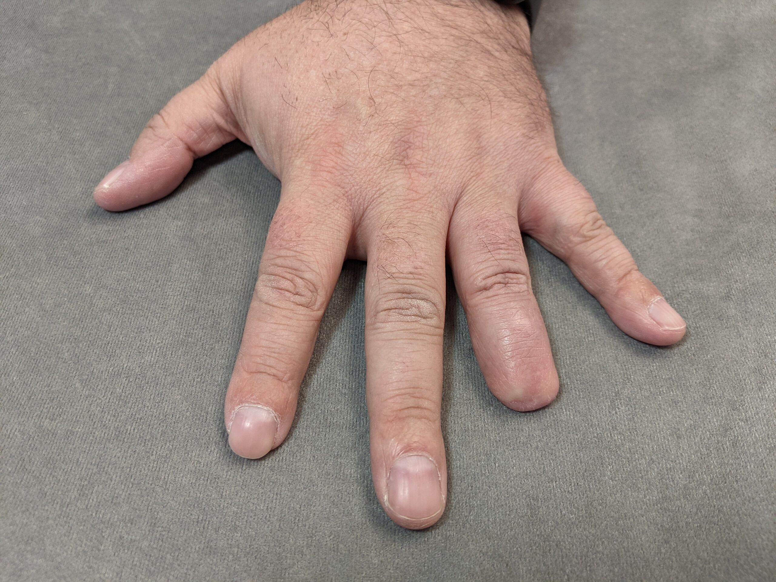 photo of amputated index and ring fingers