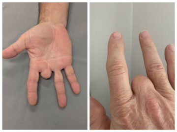 Photo of a man with amputated middle finger