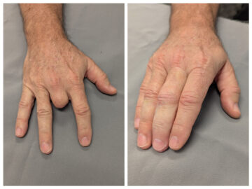 Photo of middle missing middle finger and the prosthetic finger to restore the appearance