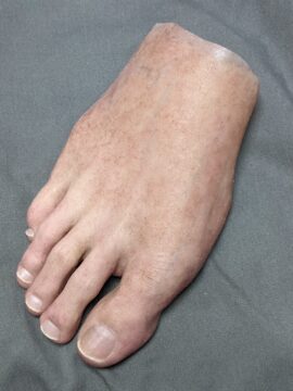 Quality Custom Silicone Foot and Toe Prosthetic