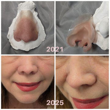 prosthetic noses on plaster base and glued onto the patient with perfect blend