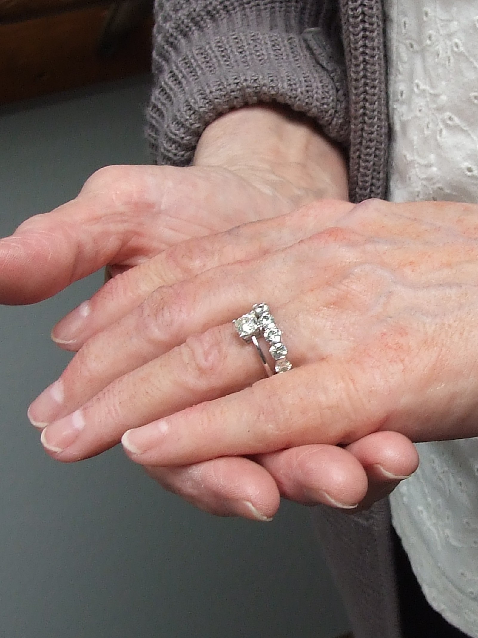 Hands with prosthetic hand
