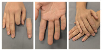photos of an index finger prosthesis on young woman