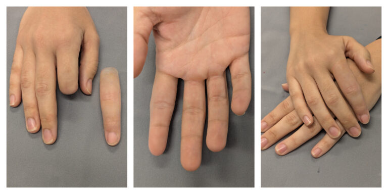 photos of an index finger prosthesis on young woman