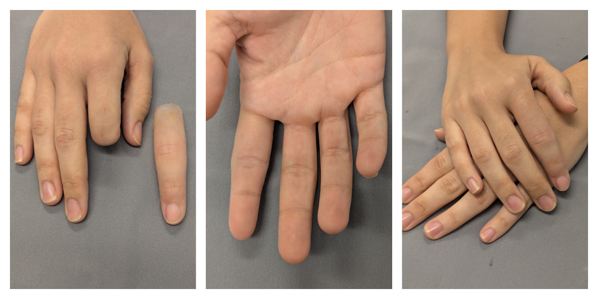 photos of an index finger prosthesis on young woman