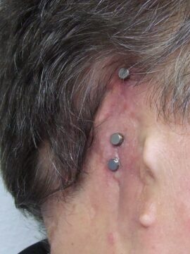 bone anchored fixtures with abutments and caps for ear prosthetis