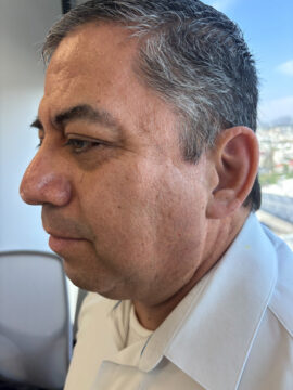 man with prosthetic ear reconstruction
