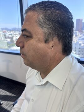 photo of man with amputated left pinna