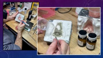 photos of the molding making of a nasal prosthesis