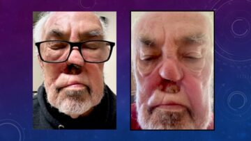 photo of man with subtotal rhinectomy