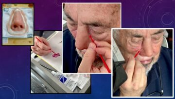 photos in a series showing the custom coloring of a nasal prosthesis