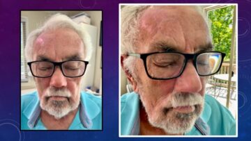 photos of a highly detailed nasal prosthesis after rhinectomy